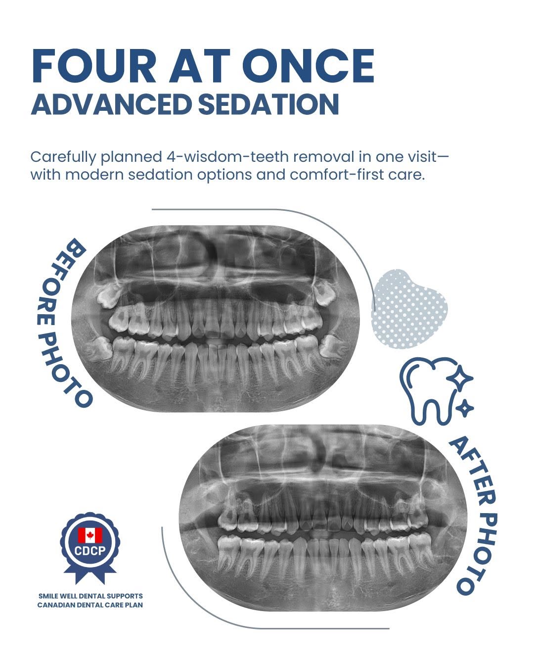 Sedation Dentistry in Vancouver